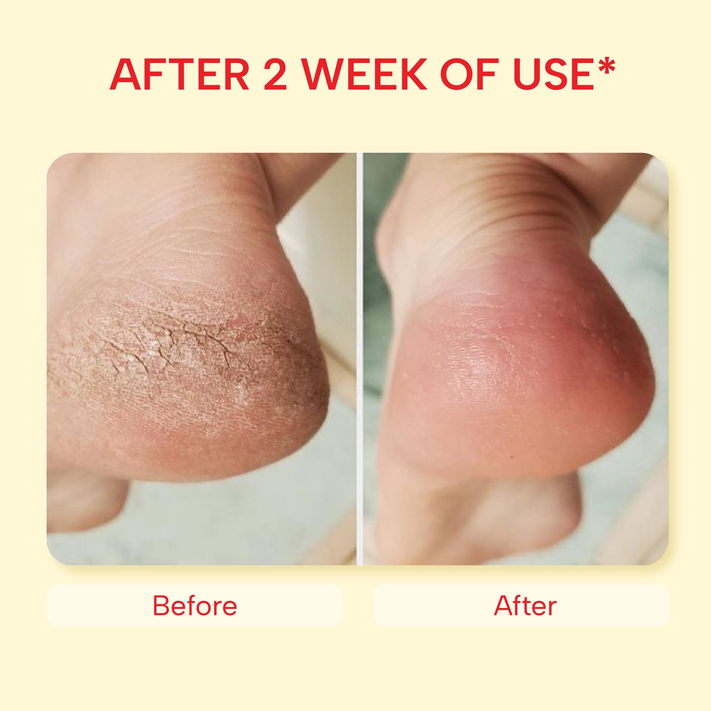 Heel Repair