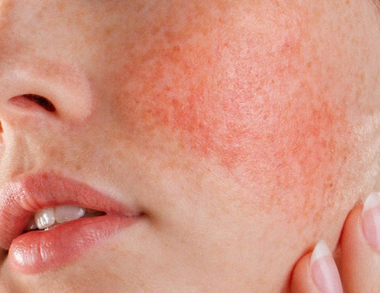 Tadheen Skin Care Solutions for All Your Skin Concerns: From Acne to Dry Skin