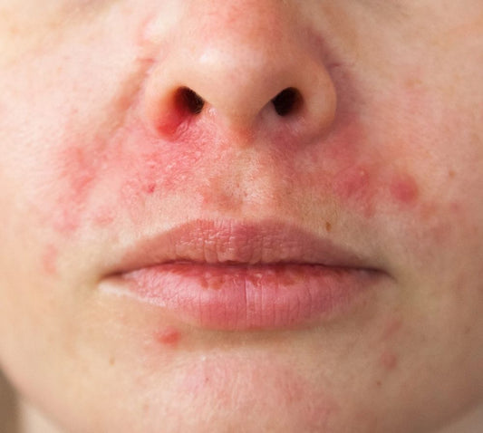 Everything You Need to Know About Eczema – According to Dermatologists